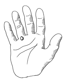 Retinacular Cyst
